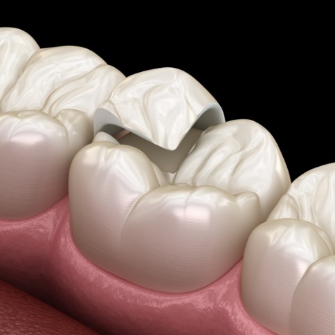 Illustration of dental onlay being placed on tooth