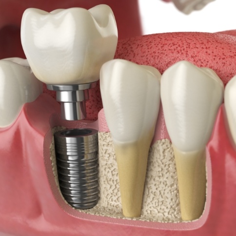 Illustration of dental crown being attached to dental implant