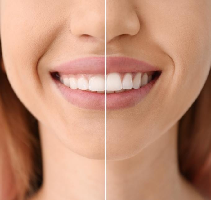 Smile before and after gum recontouring in Albuquerque