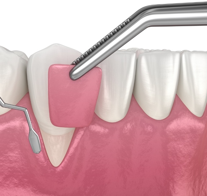 Illustration of gum recontouring process