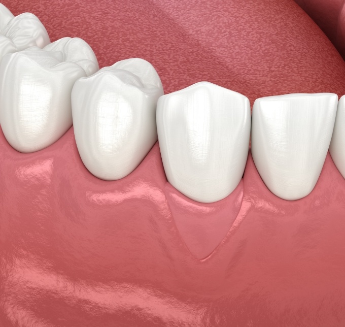 Illustration of multiple teeth in lower arch