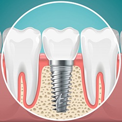 illustration of a dental implant in Albuquerque