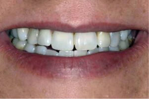 Close up of smile with discolored teeth