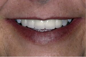After image of improved smile