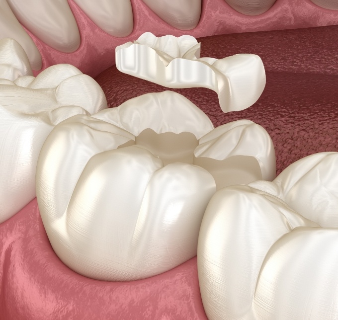 Illustration of a dental inlay in Albuquerque placed in tooth