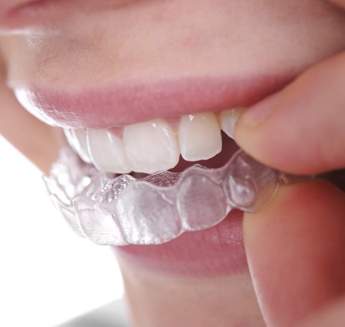 Close up of Invisalign aligners being placed on upper teeth