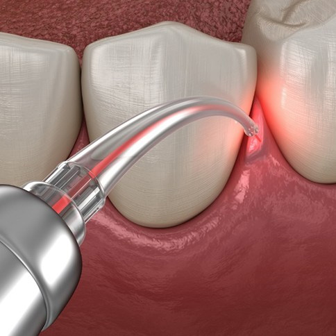 Dental laser treating gum disease tissues