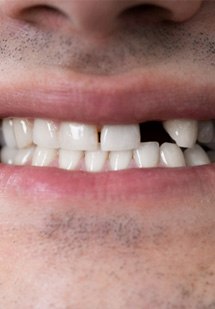 Patient East talking about tooth replacement