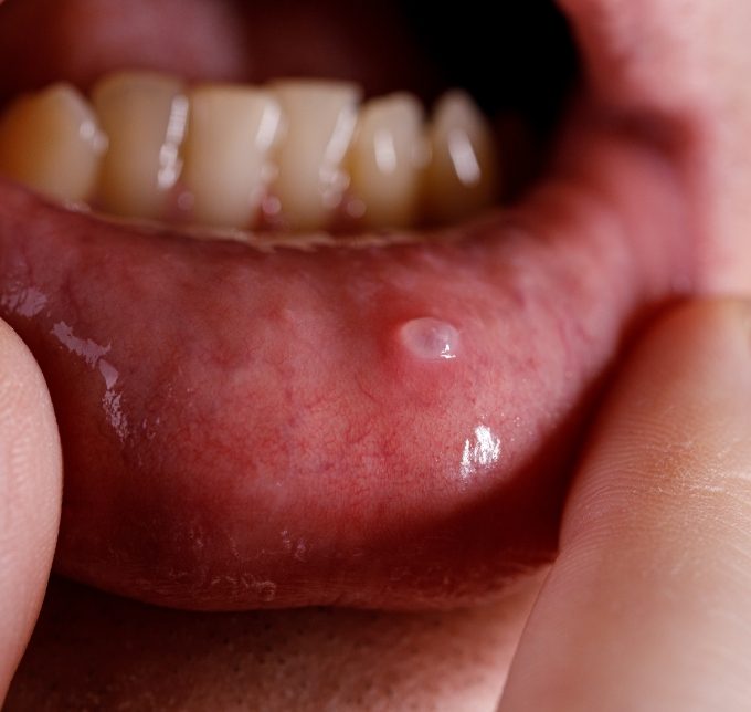 Close up of patients lips and gums