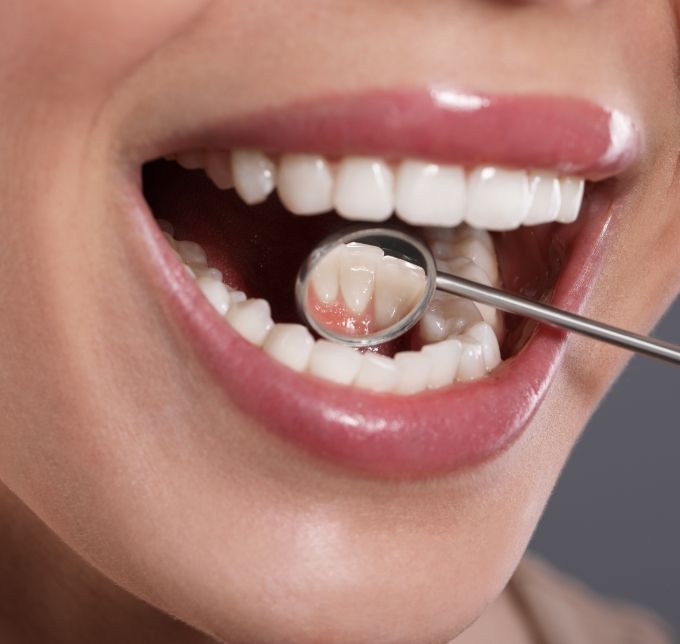 Close up of womans mouth with dental mirror examining teeth