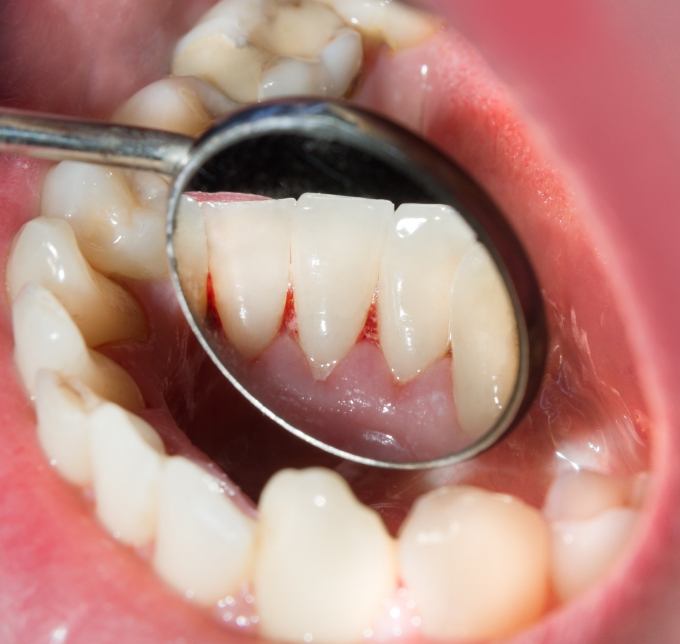 Dental mirror showing signs of oral cancer
