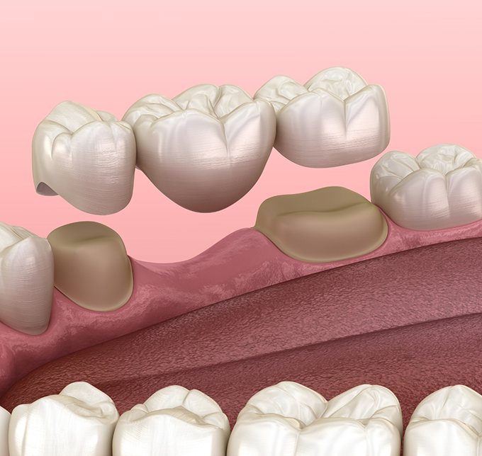 Illustrated dental bridge being placed to replace a missing tooth