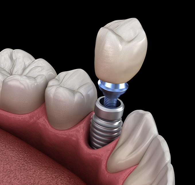 Illustrated dental crown being fitted onto a dental implant
