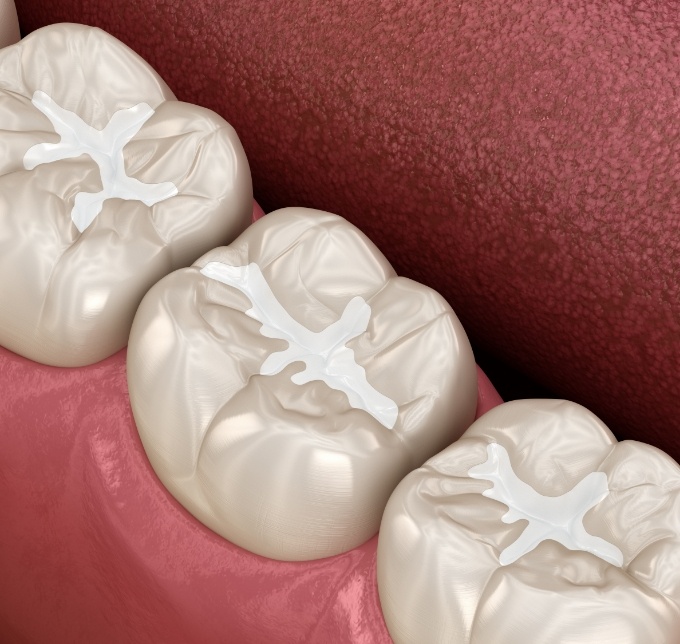 Illustration of teeth with tooth colored fillings for restorative dentistry in Albuquerque