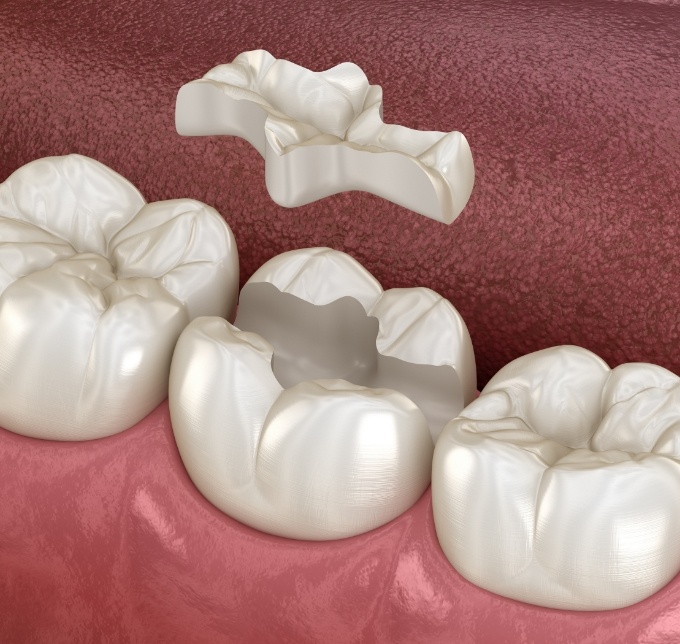 Illustration of an inlay being placed in a tooth