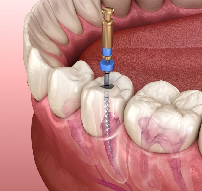 Illustration of root canal treatment in Albuquerque for tooth in lower arch