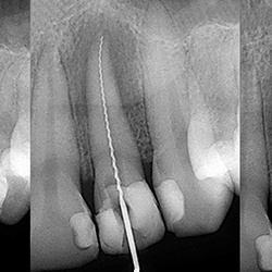 tooth getting root canal