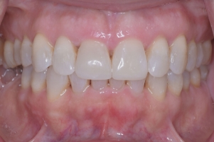 Close up of a smile with stainless white teeth