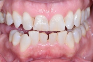 Close up of a smile with a few stained teeth