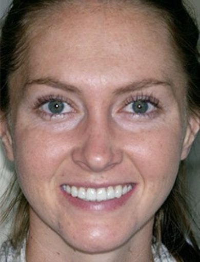 Albuquerque dental patient Allison smiling
