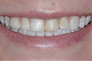 Close up of a smile with a few stained teeth