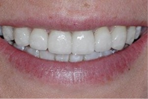 Close up of a smile with stainless white teeth