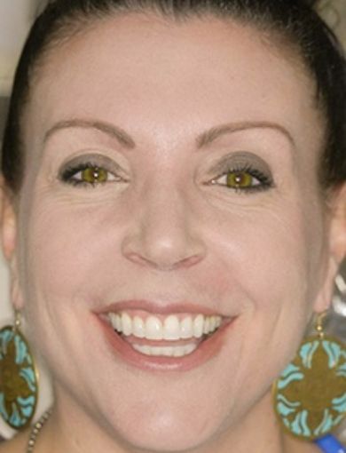 Dental patient Anna smiling