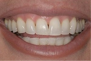 Close up of a smile with slightly gapped teeth