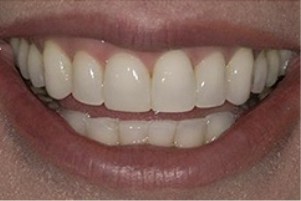 Close up of a smile with evenly spaced teeth