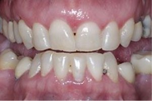 Close up of a mouth with misaligned teeth
