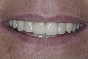 Close up of a mouth with well aligned teeth