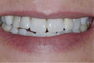 Close up of a mouth with slightly misaligned and discolored teeth