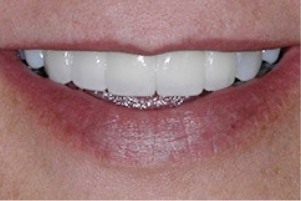 Close up of a mouth with whiter and well aligned teeth