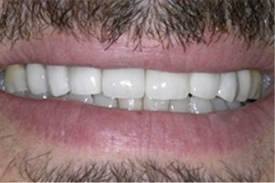 Smile with slightly discolored teeth