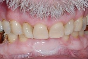 Mouth with yellowed teeth