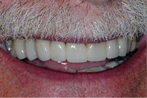 Mouth with whitened teeth