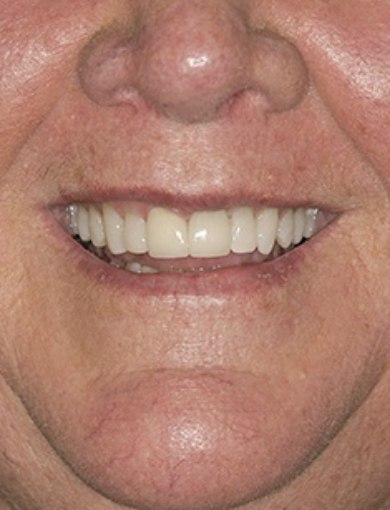 Close up of a smile with straight white teeth after dental treatment