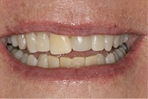 Close up of a smile with slightly discolored and misaligned teeth