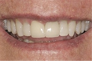 Close up of a smile with straight white teeth after dental treatment