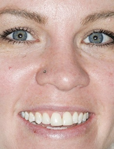 Dental patient Kasey smiling