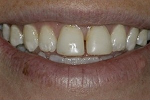 Close up of a smile with slightly darkened teeth