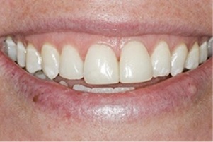Close up of a smile after whitening teeth