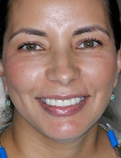 Dental patient Kim smiling