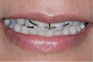 Close up of a smile with braces on upper row of teeth