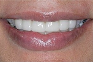 Close up of smile with straight teeth after orthodontic treatment