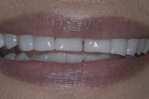 Close up of a smile with a few stained teeth