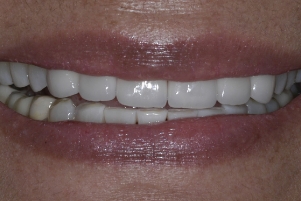 Close up of a smile with stainless white teeth