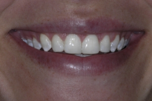 Close up of a smile with stainless white teeth