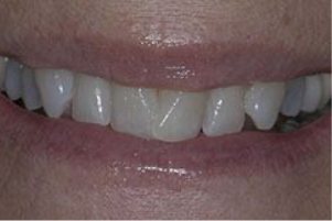 Mouth with slightly crowded teeth