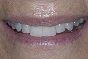 Mouth with evenly spaced and aligned teeth